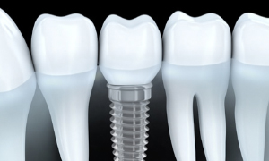 IMPLANTES